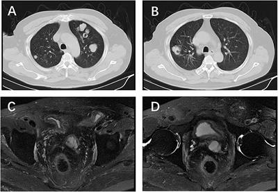 Frontiers | An Unusual Case Of Metastatic Basal Cell Carcinoma Of The ...